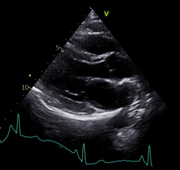 2 D Echocardiogram (Parasternal long axis view)