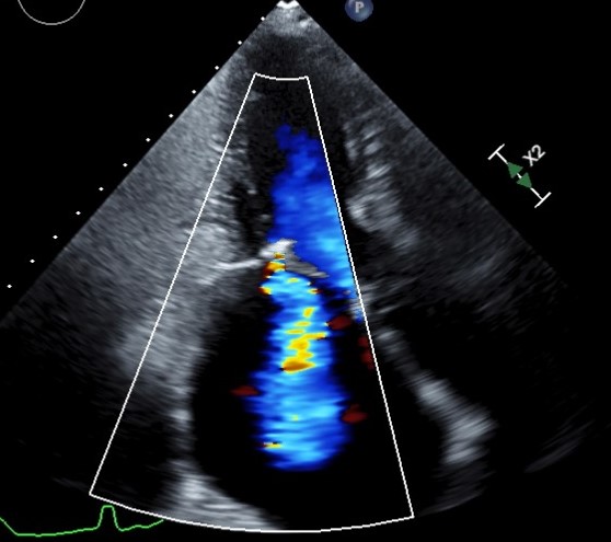 Patient with rheumatic heart disease
Echocardiography helped in diagnosis of valve problems. 